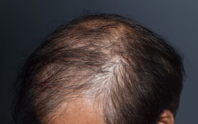 Alternative Methoden zur Vorbeugung von Haarausfall