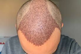 Ist eine Haartransplantation dauerhaft?